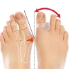 Hallux Valgus.webp